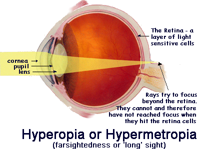 Szemész vizsgálati diagramja - Teljesen vak látássérült látásélesség