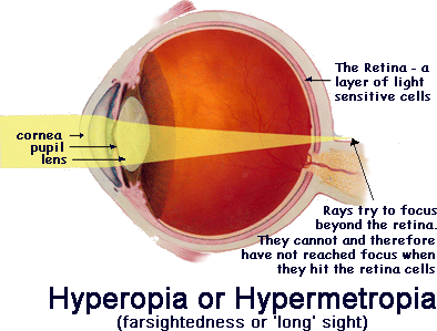 myopia diagram gcse)