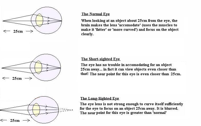 myopia diagram gcse